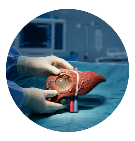 Surgery for Hydatid Cyst of Liver